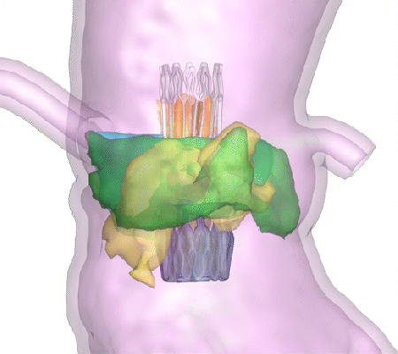 animated gif of the Dasi Simulations software showing a stent visualization