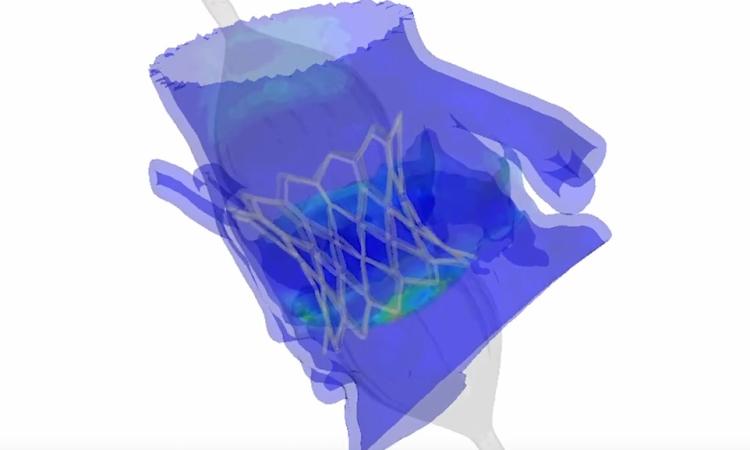 Screenshot of a computer simulation of a heart valve placement. The vessel is a purple form with the mesh around the valve partially opened inside.