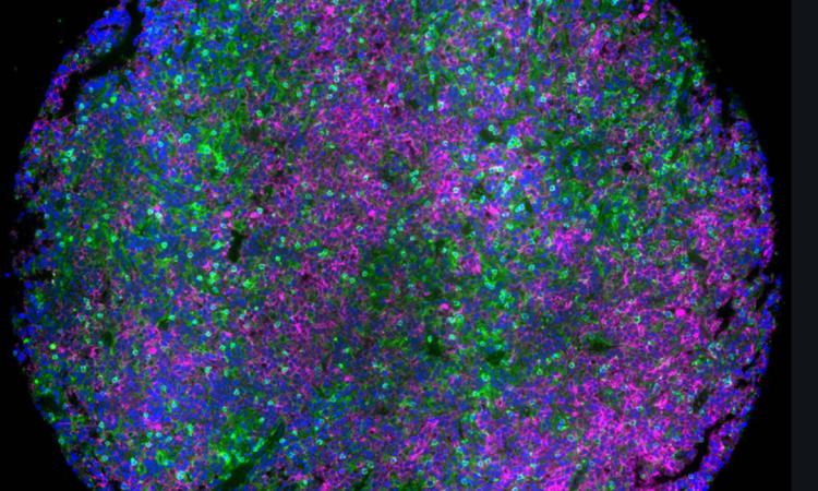 Lymph node tumor microenvironment of lymphomas with malignant B cells (magenta) surrounded by T cells (green), which induce survival mechanism in tumor cells and dampen the response to therapeutics. This microenvironment was faithfully mimicked in a 3D hydrogel of lymphoma patient tumors to discover role of tumor microenvironment in lymphomas and how combinatorial therapies can overcome resistance in tumors.  Blue: Nucleus. (Image: Mayar Allam, Ahmet Coskun, and Ankur Singh)