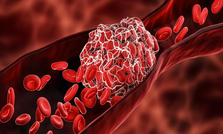 Illustration of a clot blocking a blood vessel with disc-shaped red blood cells before and after the clot.