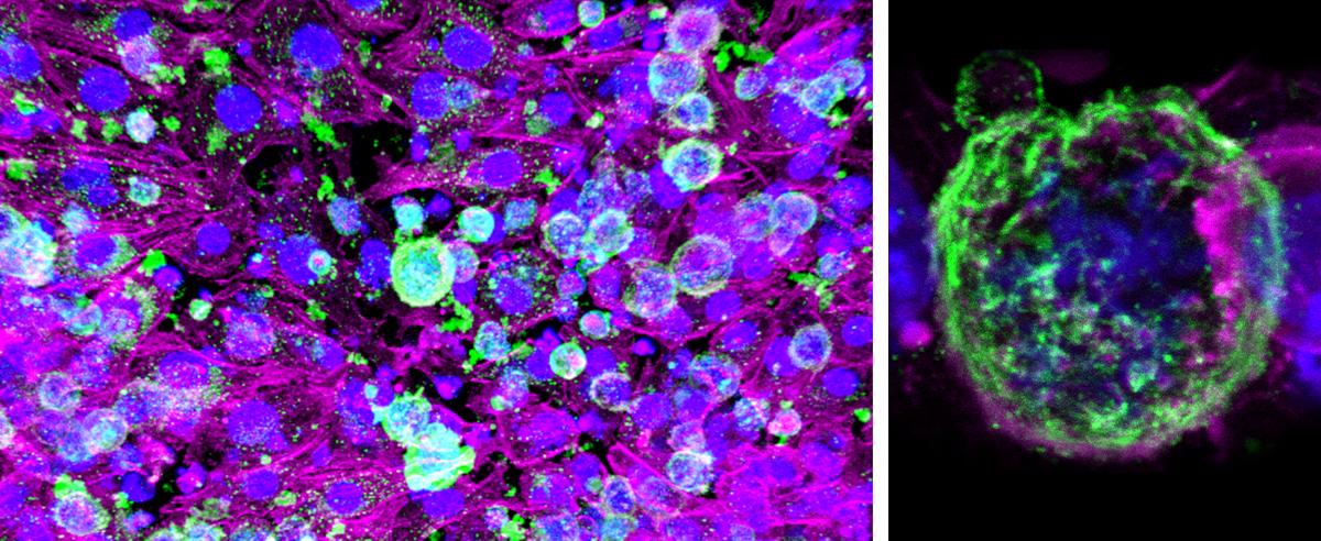 A model of a lymphoma tumor called an organoid, shown in its environment and as a closeup