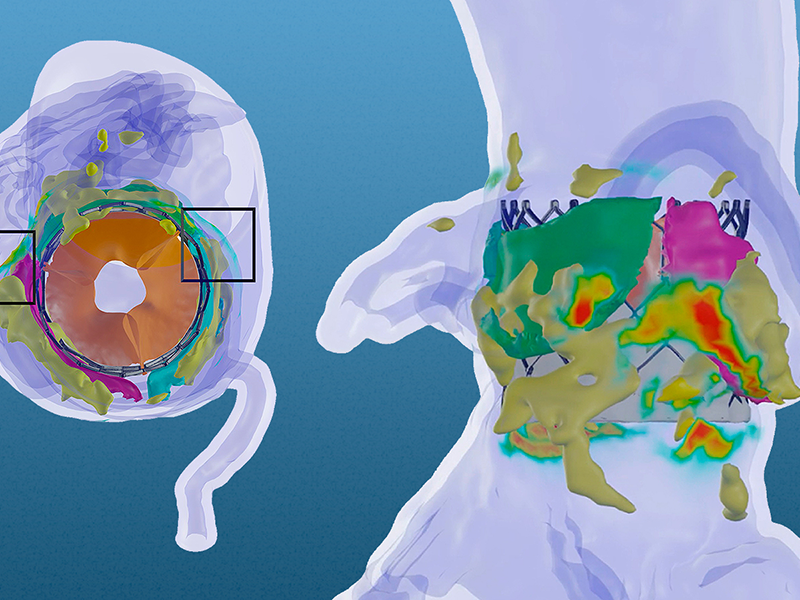 Prasad Dasi heart valve simulation